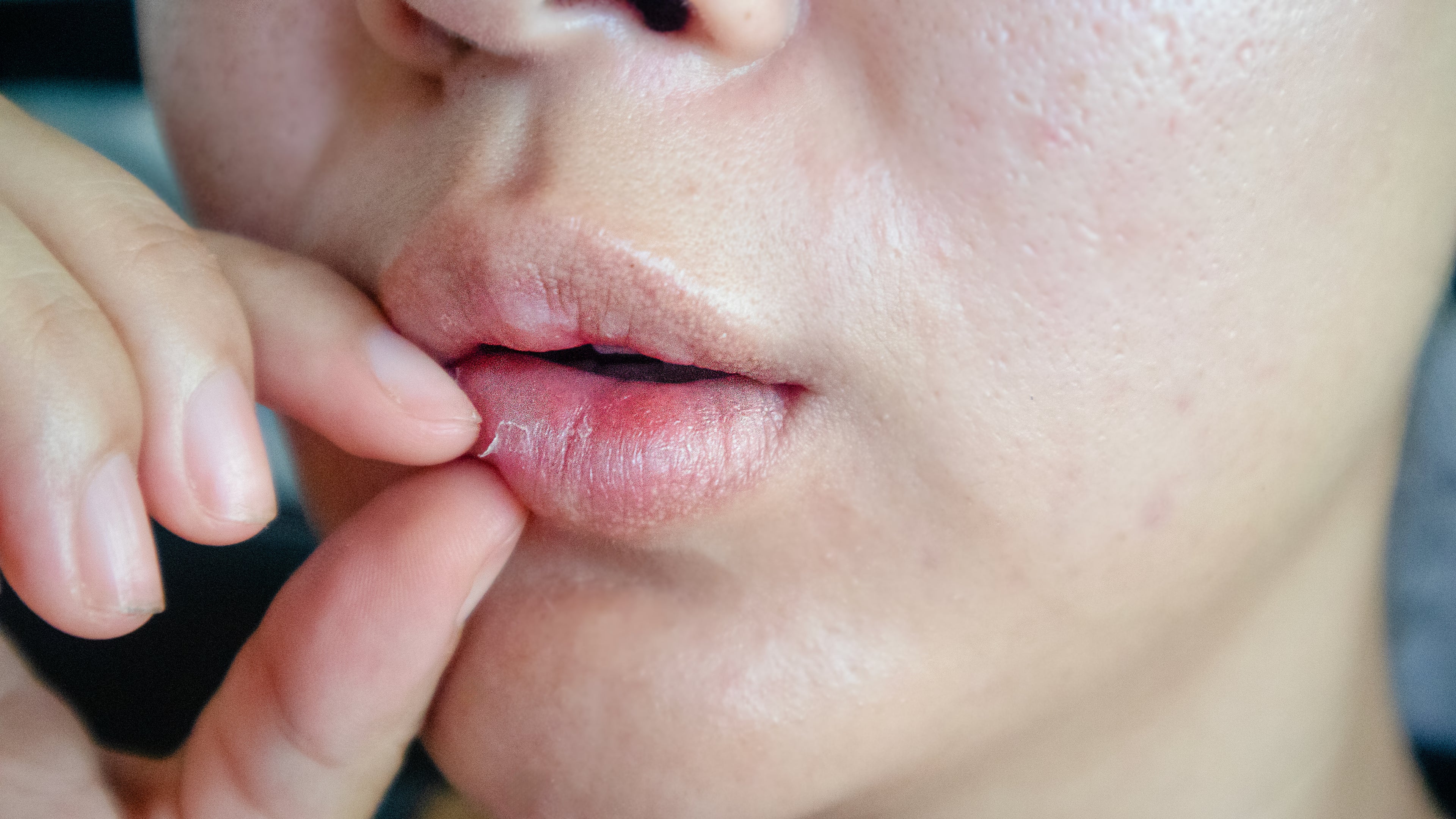 Cold Sores